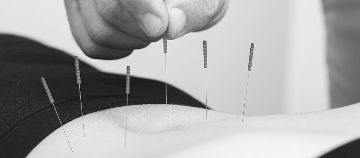 igły igłowanie akupunktura