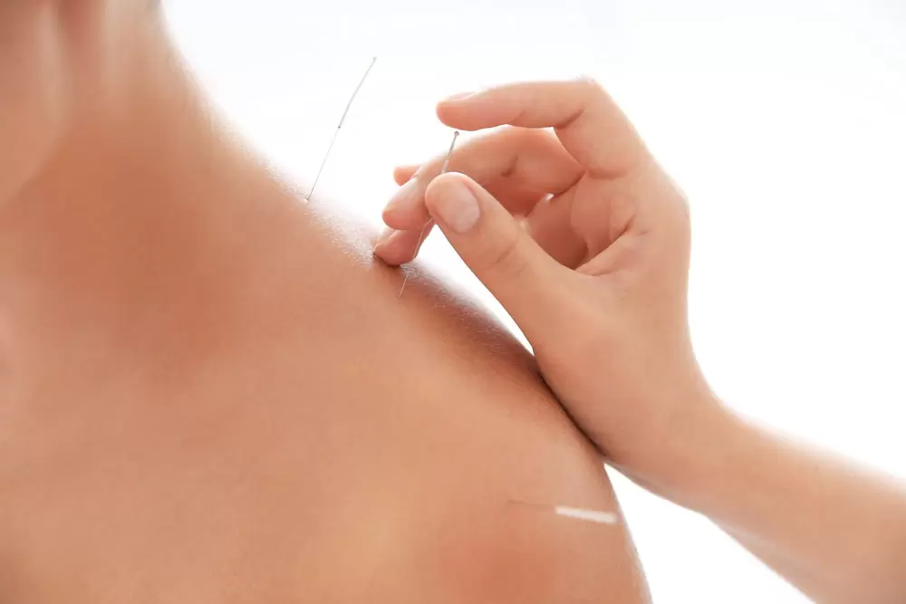 Dry needling, a akupunktura - Szkolenia FRSc