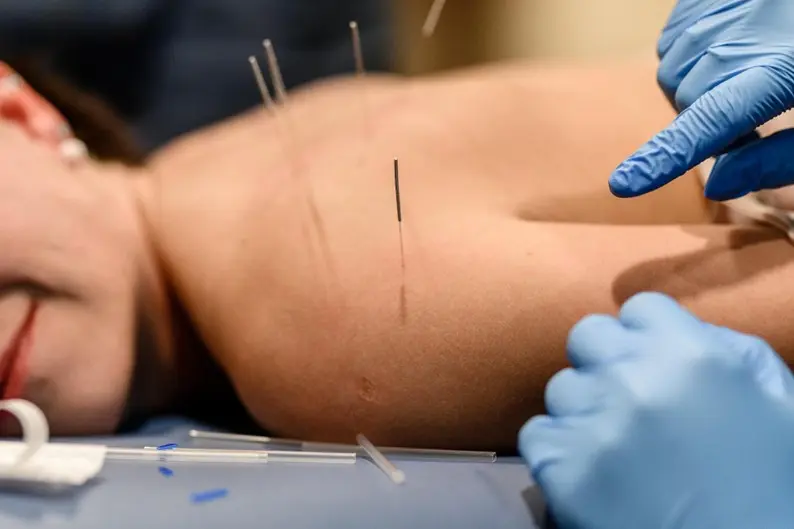 bezpieczne suche igłowanie inaczej dry needling