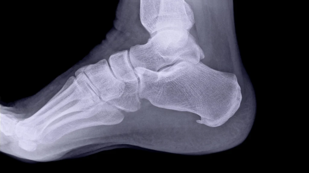 Leczenie ostrogi piętowej metodami Akupunktury Master Tung i koncepcji komplementarnych - Szkolenia FRSc