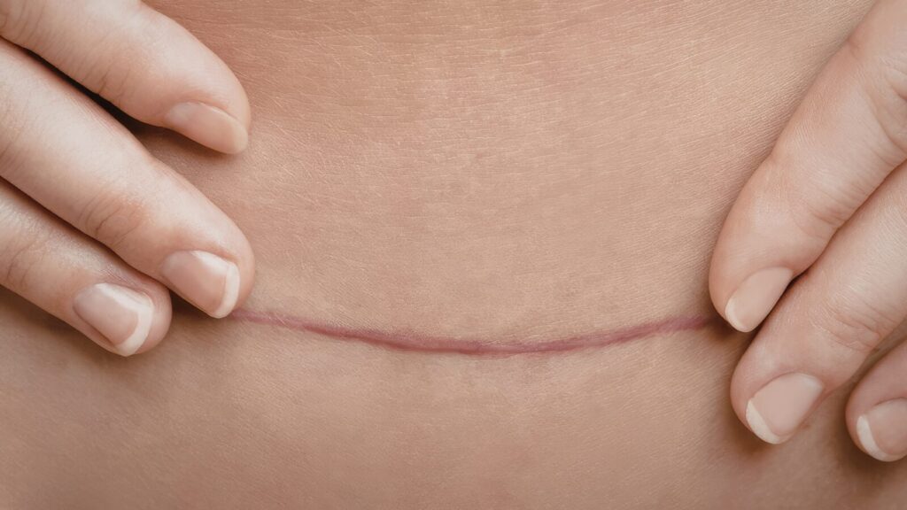 Blizna po operacji na ciele.