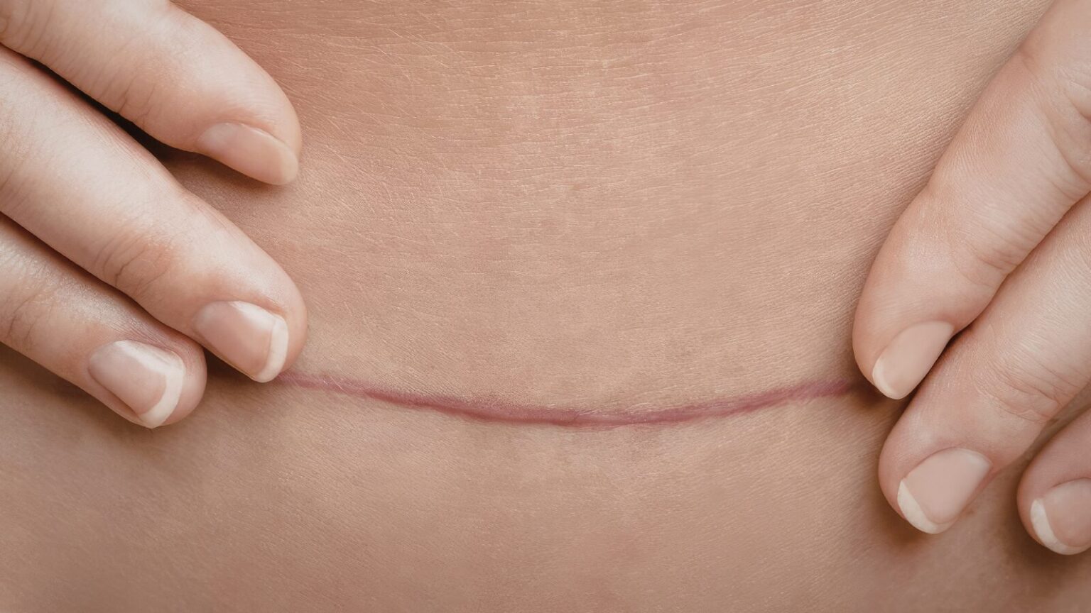 Blizna po operacji na ciele.